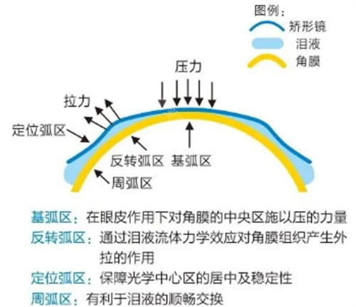 角膜塑形镜功效图示