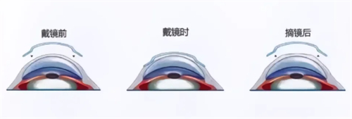 角膜塑形镜到底多久换一副？超期使用危害大，医生建议这个时限要记牢！