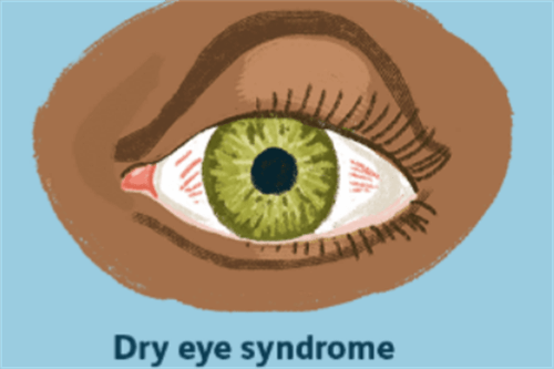 上海治疗干眼症靠谱的医院是哪家？爱尔眼科、和平眼科、新视界眼科都是做干眼靠谱的医院！