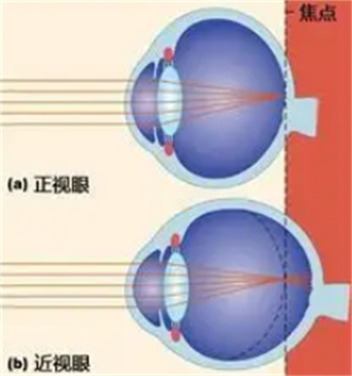 新疆一附院眼科近视眼手术价格是多少？含眼科各类近视手术方式详细价格明细！