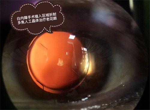 德阳白内障手术免费政策！2025年满足这些条件，手术费用不用买单