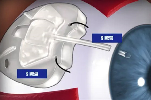 武汉爱尔眼科医院汉口医院吴立平简介:青光眼小创伤手术_白内障手术2万余例_硕士医师预约!