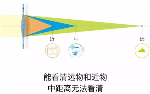 2025蔡司809双焦人工晶体价格大揭秘！5700元起涵盖基础款与散光款，不同型号价差竟达万元？