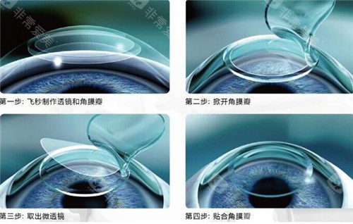 激光手术过程细节图