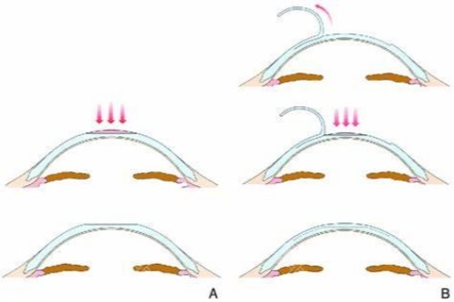 smart手术示意图
