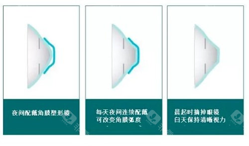 角膜塑形镜的原理