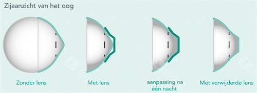 角膜塑形镜改善圆锥角膜