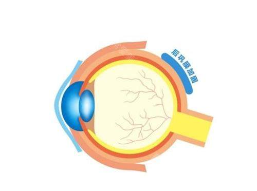 王乐今做了多少例巩膜加固术？上千例成功术例临床经验足挺可靠