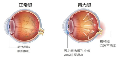 正常眼睛和青光眼的不同之处
