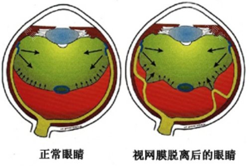 视网膜脱落卡通对比图