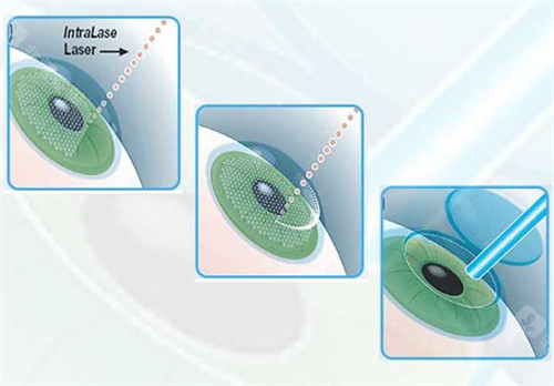近视手术过程图解