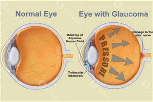 青光眼示意图