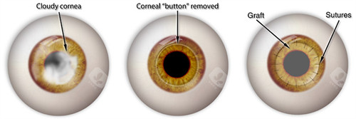 角膜移植动画图