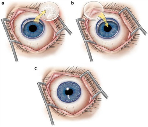 角膜移植过程展示