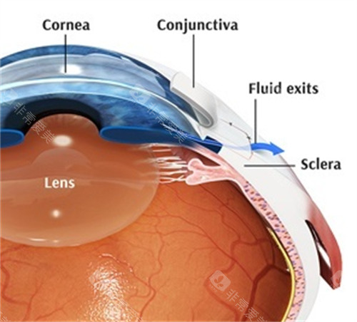 青光眼内部问题