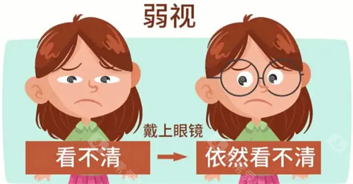 弱视眼睛视线
