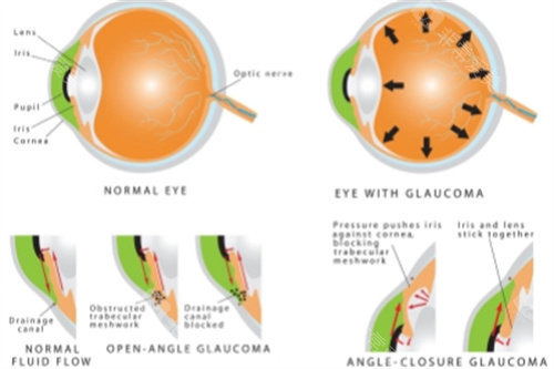 青光眼结构图