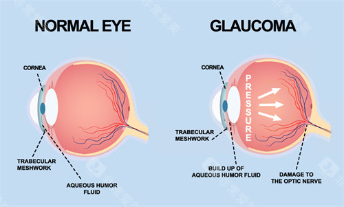 青光眼动画演示图