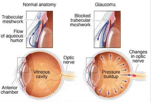 北京做青光眼手术哪家好?希玛眼科唐炘/王宁利医生值得信赖!