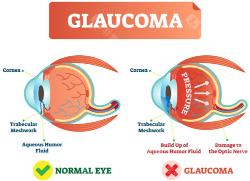 正常眼睛和青光眼的对比