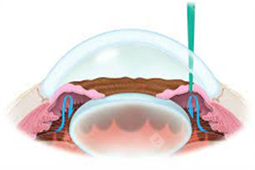 虹膜切除术 青光眼