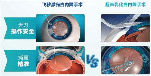 飞秒激光白内障手术和超声乳化白内障手术区别