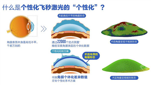 个性化微飞秒手术过程图解