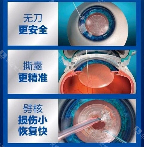 飞秒激光治疗白内障手术图
