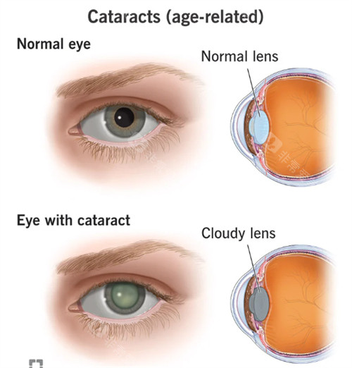 北京301医院眼科收费标准公布，白内障5000起/近视矫正12000起！