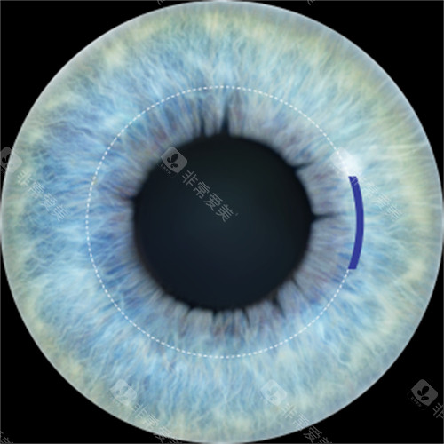 全飞秒手术切口展示