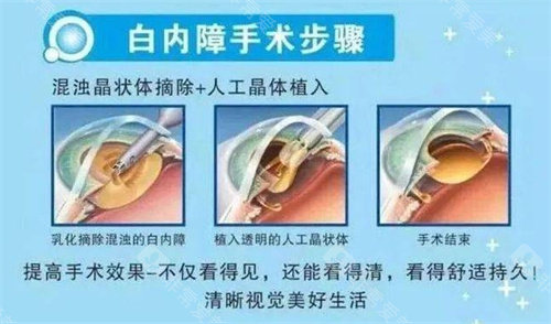 白内障手术示意图