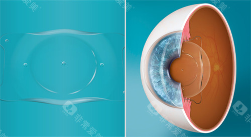 人工晶体植入眼睛演示图展示