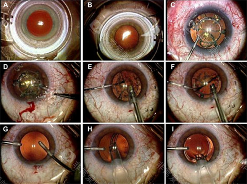全飞秒手术过程图解