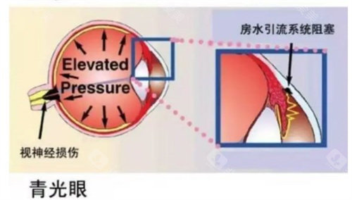 青光眼是什么原因导致的