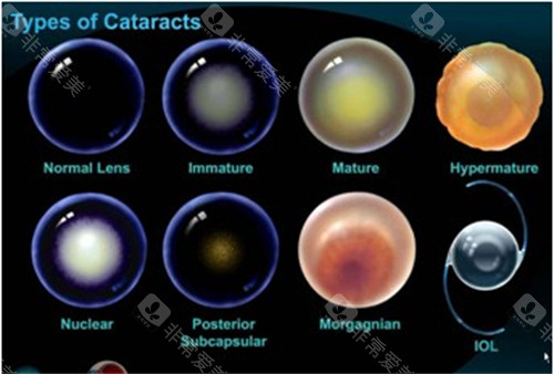 不同白内障晶体展示