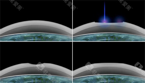 武汉市近视手术在哪家医院好？网友心中的2025年排名前三是这三家！