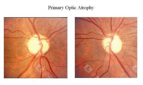 视神经萎缩的眼底