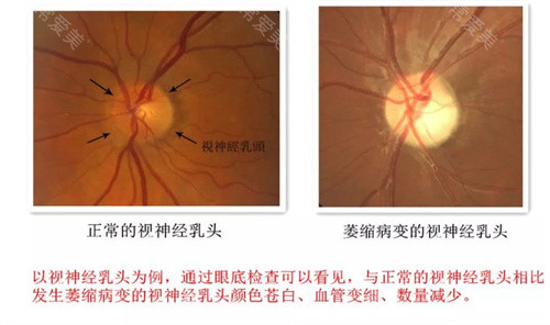 视神经萎缩对比