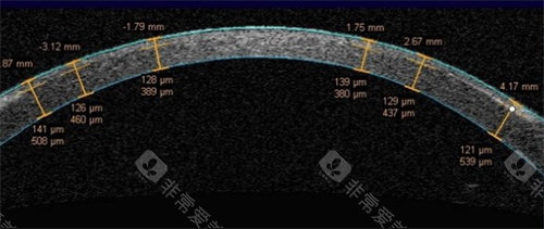 飞秒激光角膜瓣厚度