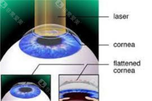 全激光手术示意图