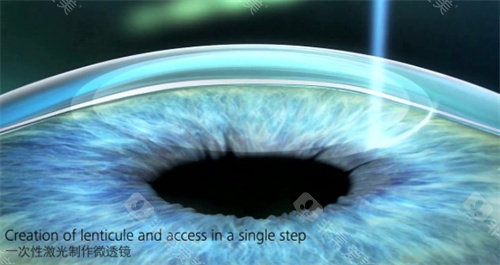 激光手术示意图