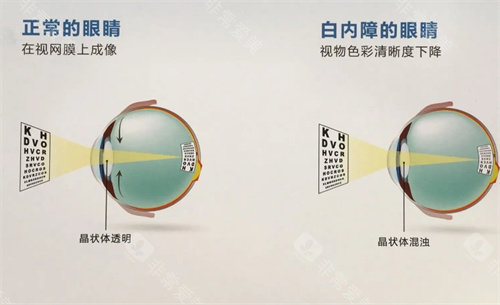 正常眼睛和白内障眼睛的对比图