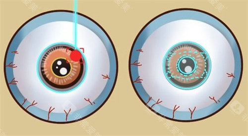激光类近视手术和ICL晶体植入手术