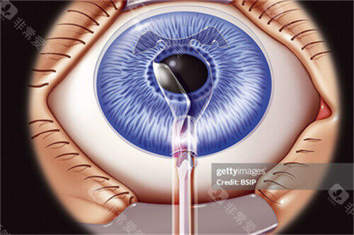 icl晶体植入手术
