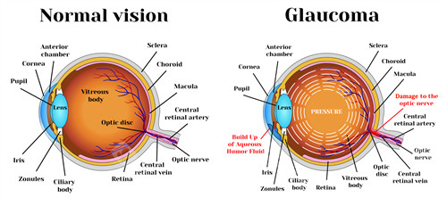 青光眼结构
