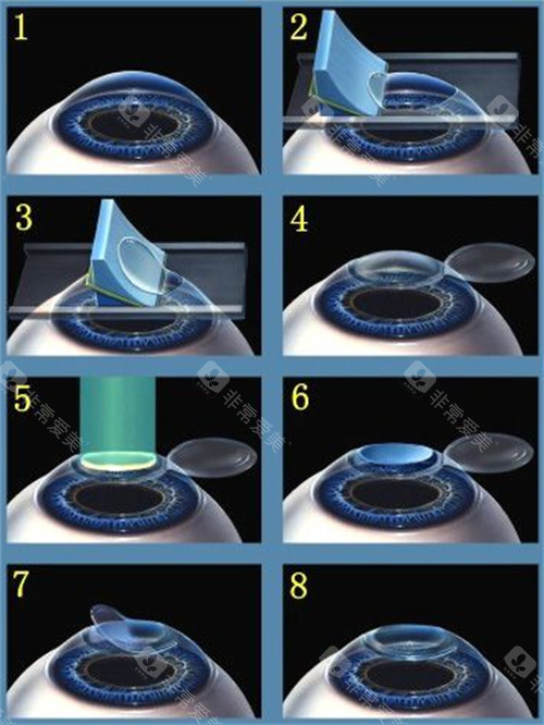 近视手术的手术过程