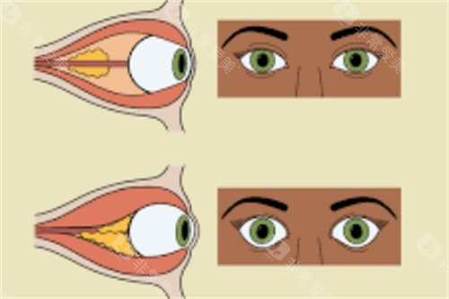近视眼球对比图