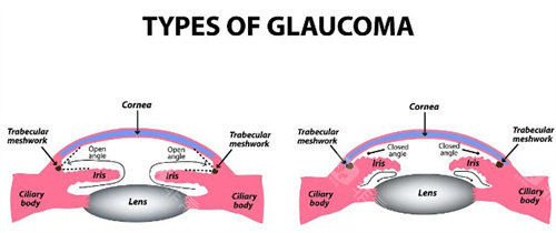 开角型和闭角型青光眼