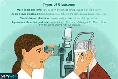 青光眼的类型