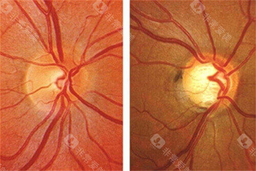 青光眼眼球示意图